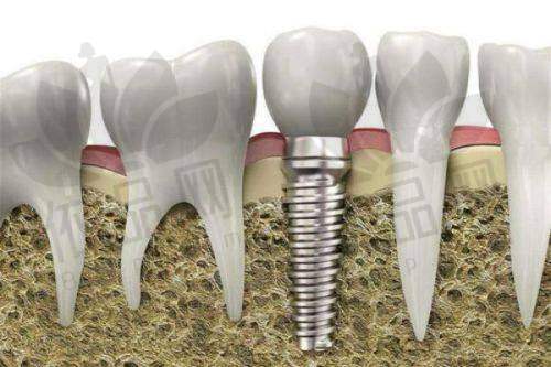 柳州蓝天口腔有种植牙资质吗？收费贵吗？