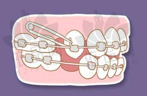 为什么医生不建议拔智齿?——手术风险不可忽视