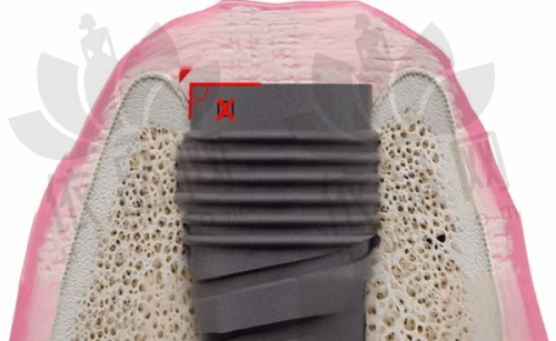 为什么医生不建议拔智齿?——总结与建议