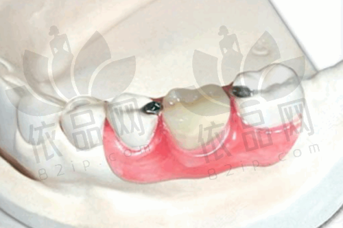 为什么医生不建议拔智齿?——智齿情况影响决策