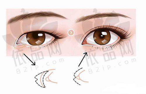 热门毛发移植项目