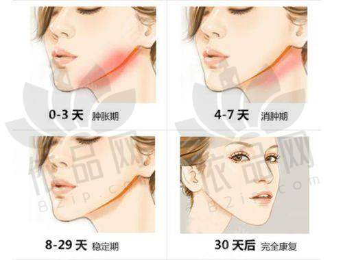 看型号辨别傲诺拉假体真假