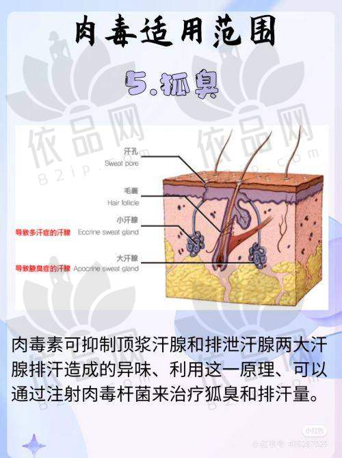 双环法乳房提升术