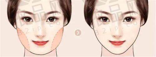 福州新世纪整形外科陈志明医生的特色技术优势