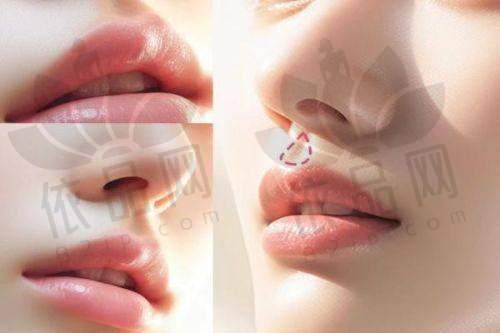 深圳福雅胡俊杰人中缩短技术超好,不留疤超自然,8800元起性价比高