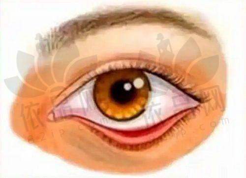 郑州张芳双眼皮修复价格多少钱?2025年张芳双眼皮修复费用在3500 - 25600元起