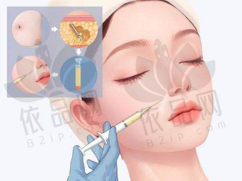 厦门脸博士杨青青注射玻尿酸2200元起填充额头，改善凹陷显饱满，个性化方案优势多！