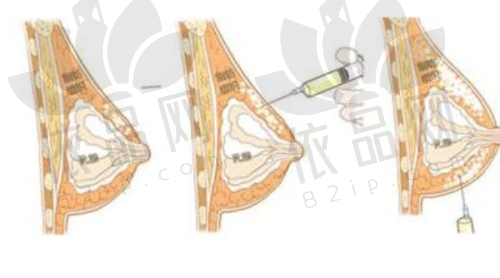 栗勇和肖征刚隆胸哪个好?栗勇内窥镜隆胸出色,肖征刚隆胸修复有实力各有千秋