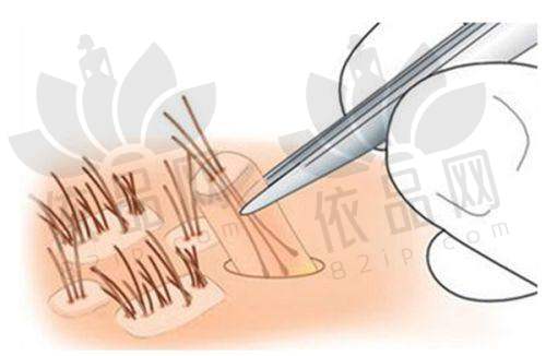 福州前十强微创植发医院