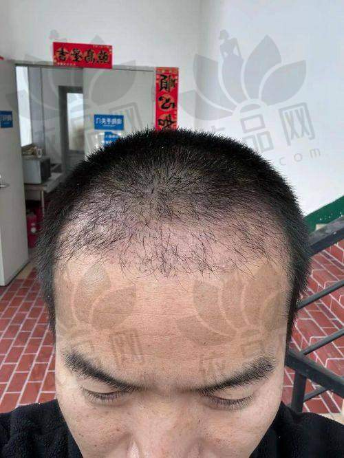 福州东方整形美容门诊部:该医院位于北环东路福州汽车站北站出口正对面,2000年就已成立,各项资质均经过卫生部门正式批准,是当地规模较大的整形美容机构。除了常规的眼鼻整形、胸部整形、口唇整形外,毛发种植是其特色治疗项目。设施配置按照国有医院标准配备,还有层流洁净手术室,能让患者在治疗过程中更加安心洁净,治疗成果也更优良。门诊长期与国外整形外科合作,致力于为爱美人士打造个性化服务,口碑和评价都特别高。